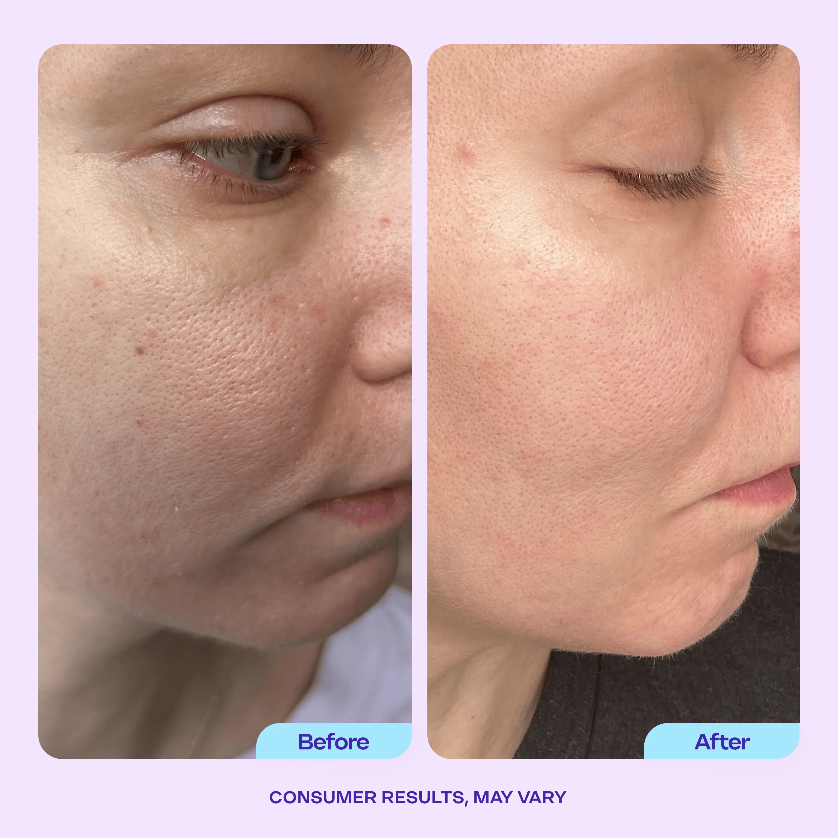 Try Before You Buy - Refine It! BHA Liquid Exfoliant - Image 3